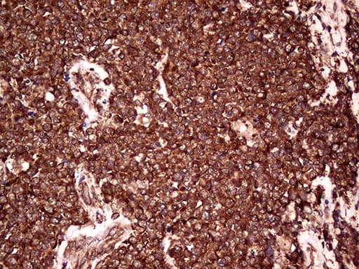 Immunohistochemical staining of paraffin-embedded Human lymphoma tissue using anti-RPL10A mouse monoclonal antibody. Heat-induced epitope retrieval by EDTA solution buffer pH 8.0 at 120Â°C for 3 min.