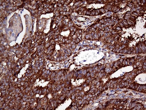 Immunohistochemical staining of paraffin-embedded Adenocarcinoma of Human endometrium tissue using anti-RPL10A mouse monoclonal antibody. Heat-induced epitope retrieval by EDTA solution buffer pH 8.0 at 120Â°C for 3 min.