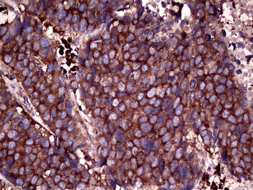 Immunohistochemical staining of paraffin-embedded Carcinoma of Human lung tissue using anti-RPL10A mouse monoclonal antibody. Heat-induced epitope retrieval by EDTA solution buffer pH 8.0 at 120Â°C for 3 min.