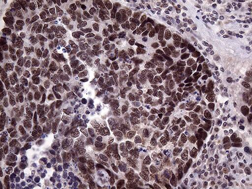 Immunohistochemical staining of paraffin-embedded Carcinoma of Human lung tissue using anti-LHX4 mouse monoclonal antibody. Heat-induced epitope retrieval by EDTA solution buffer pH 8.0 at 120Â°C for 3 min.