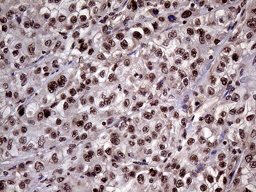 Immunohistochemical staining of paraffin-embedded Carcinoma of Human kidney tissue using anti-LHX4 mouse monoclonal antibody. Heat-induced epitope retrieval by EDTA solution buffer pH 8.0 at 120Â°C for 3 min.