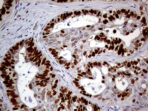 Immunohistochemical staining of paraffin-embedded Adenocarcinoma of Human ovary tissue using anti-MEIS1 mouse monoclonal antibody. Heat-induced epitope retrieval by EDTA solution buffer pH 8.0 at 120Â°C for 3 min.