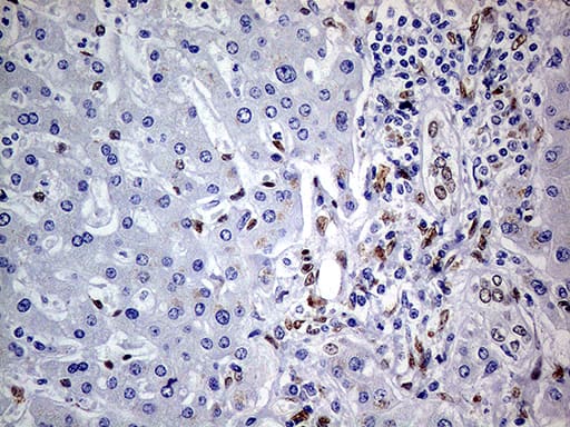 Immunohistochemical staining of paraffin-embedded Carcinoma of Human liver tissue using anti-MEIS1 mouse monoclonal antibody. Heat-induced epitope retrieval by EDTA solution buffer pH 8.0 at 120Â°C for 3 min.
