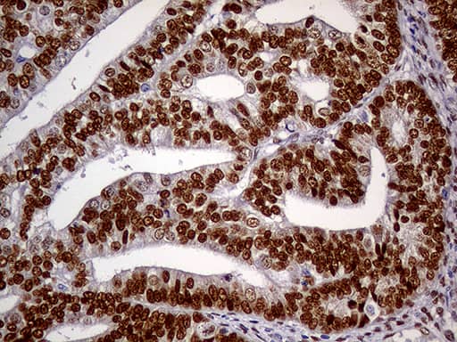 Immunohistochemical staining of paraffin-embedded Adenocarcinoma of Human endometrium tissue using anti-MEIS1 mouse monoclonal antibody. Heat-induced epitope retrieval by EDTA solution buffer pH 8.0 at 120Â°C for 3 min.