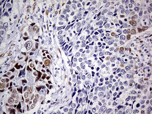 Immunohistochemical staining of paraffin-embedded Carcinoma of Human lung tissue using anti-MEIS1 mouse monoclonal antibody. Heat-induced epitope retrieval by EDTA solution buffer pH 8.0 at 120Â°C for 3 min.