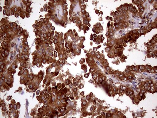 Immunohistochemical staining of paraffin-embedded Carcinoma of Human thyroid tissue using anti-RRBP1 mouse monoclonal antibody. Heat-induced epitope retrieval by EDTA solution buffer pH 8.0 at 120Â°C for 3 min.