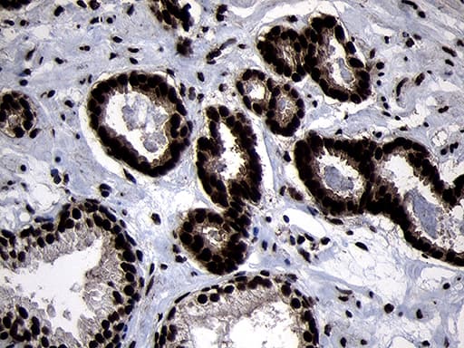 Immunohistochemical staining of paraffin-embedded Carcinoma of Human prostate tissue using anti-HOXC4 mouse monoclonal antibody. Heat-induced epitope retrieval by EDTA solution buffer pH 8.0 at 120Â°C for 3 min.