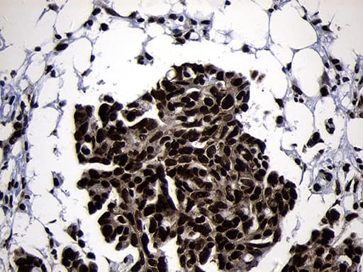 Immunohistochemical staining of paraffin-embedded Adenocarcinoma of Human ovary tissue using anti-HOXC4 mouse monoclonal antibody. Heat-induced epitope retrieval by EDTA solution buffer pH 8.0 at 120Â°C for 3 min.