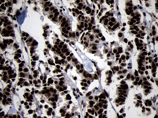 Immunohistochemical staining of paraffin-embedded Carcinoma of Human pancreas tissue using anti-HOXC4 mouse monoclonal antibody. Heat-induced epitope retrieval by EDTA solution buffer pH 8.0 at 120Â°C for 3 min.