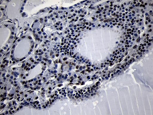Immunohistochemical staining of paraffin-embedded Carcinoma of Human thyroid tissue using anti-HOXC4 mouse monoclonal antibody. Heat-induced epitope retrieval by EDTA solution buffer pH 8.0 at 120Â°C for 3 min.