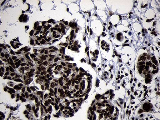 Immunohistochemical staining of paraffin-embedded Adenocarcinoma of Human ovary tissue using anti-HOXC4 mouse monoclonal antibody. Heat-induced epitope retrieval by EDTA solution buffer pH 8.0 at 120Â°C for 3 min.