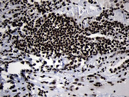 Immunohistochemical staining of paraffin-embedded Carcinoma of Human lung tissue using anti-HOXC4 mouse monoclonal antibody. Heat-induced epitope retrieval by EDTA solution buffer pH 8.0 at 120Â°C for 3 min.
