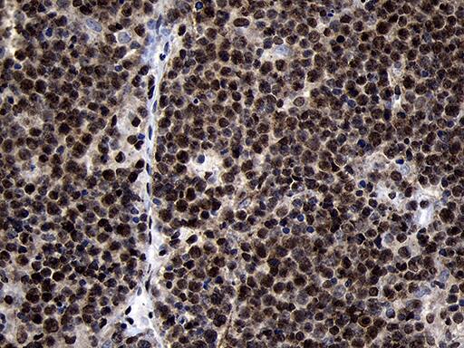 Immunohistochemical staining of paraffin-embedded Human lymphoma tissue using anti-HOXC4 mouse monoclonal antibody. Heat-induced epitope retrieval by EDTA solution buffer pH 8.0 at 120Â°C for 3 min.