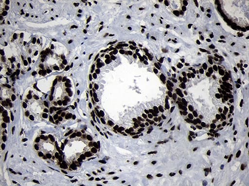 Immunohistochemical staining of paraffin-embedded Carcinoma of Human prostate tissue using anti-HOXC4 mouse monoclonal antibody. Heat-induced epitope retrieval by EDTA solution buffer pH 8.0 at 120Â°C for 3 min.