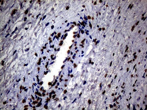 Immunohistochemical staining of paraffin-embedded Adenocarcinoma of Human ovary tissue using anti-SH3BGRL mouse monoclonal antibody. Heat-induced epitope retrieval by EDTA solution buffer pH 8.0 at 120Â°C for 3 min.