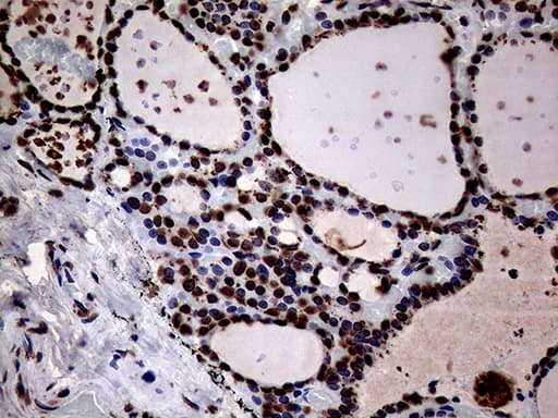 Immunohistochemical staining of paraffin-embedded Human thyroid tissue within the normal limits using anti-SH3BGRL mouse monoclonal antibody. Heat-induced epitope retrieval by EDTA solution buffer pH 8.0 at 120Â°C for 3 min.