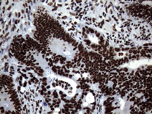 Immunohistochemical staining of paraffin-embedded Adenocarcinoma of Human colon tissue using anti-SH3BGRL mouse monoclonal antibody. Heat-induced epitope retrieval by EDTA solution buffer pH 8.0 at 120Â°C for 3 min.