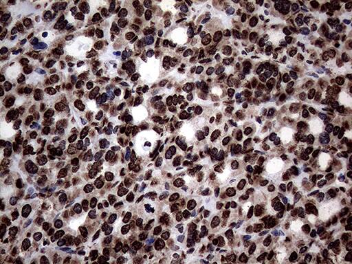 Immunohistochemical staining of paraffin-embedded Carcinoma of Human thyroid tissue using anti-SH3BGRL mouse monoclonal antibody. Heat-induced epitope retrieval by EDTA solution buffer pH 8.0 at 120Â°C for 3 min.