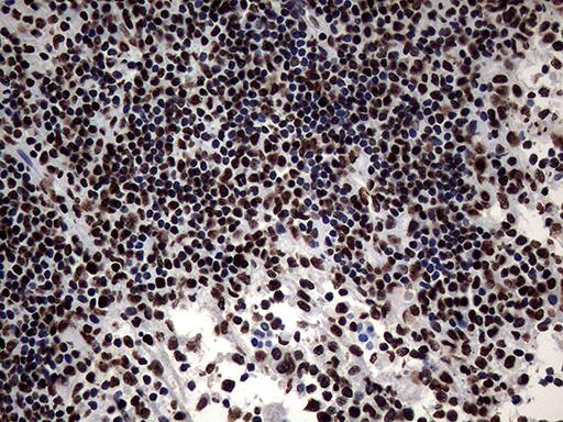 Immunohistochemical staining of paraffin-embedded Carcinoma of Human lung tissue using anti-SH3BGRL mouse monoclonal antibody. Heat-induced epitope retrieval by EDTA solution buffer pH 8.0 at 120Â°C for 3 min.