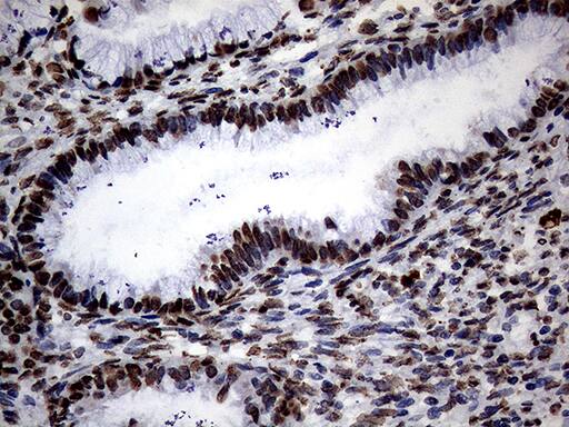 Immunohistochemical staining of paraffin-embedded Adenocarcinoma of Human endometrium tissue using anti-SH3BGRL mouse monoclonal antibody. Heat-induced epitope retrieval by EDTA solution buffer pH 8.0 at 120Â°C for 3 min.