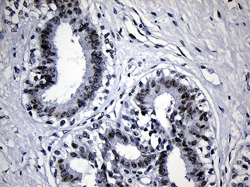 Immunohistochemical staining of paraffin-embedded Human breast tissue within the normal limits using anti-SUPT16H mouse monoclonal antibody. Heat-induced epitope retrieval by EDTA solution buffer pH 8.0 at 120Â°C for 3 min.