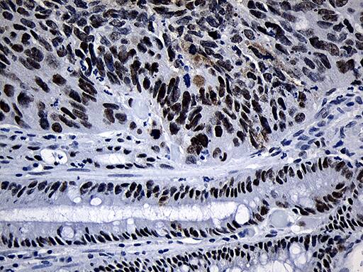 Immunohistochemical staining of paraffin-embedded Adenocarcinoma of Human colon tissue using anti-SUPT16H mouse monoclonal antibody. Heat-induced epitope retrieval by EDTA solution buffer pH 8.0 at 120Â°C for 3 min.
