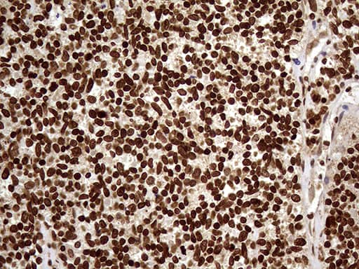 Immunohistochemical staining of paraffin-embedded Carcinoma of Human kidney tissue using anti-DDX19A mouse monoclonal antibody. Heat-induced epitope retrieval by EDTA solution buffer pH 8.0 at 120Â°C for 3 min.