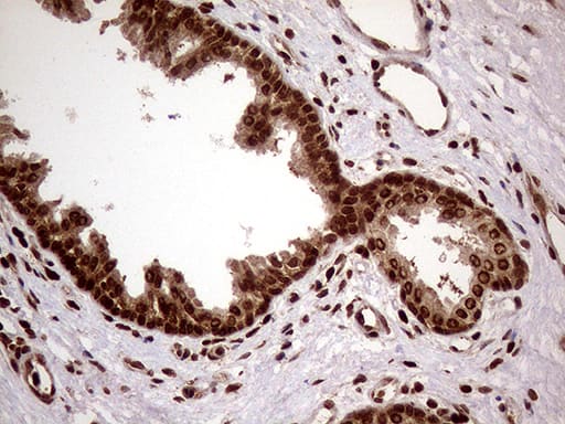 Immunohistochemical staining of paraffin-embedded Carcinoma of Human prostate tissue using anti-DDX19A mouse monoclonal antibody. Heat-induced epitope retrieval by EDTA solution buffer pH 8.0 at 120Â°C for 3 min.