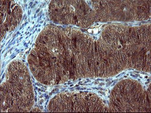 Immunohistochemical staining of paraffin-embedded Adenocarcinoma of Human ovary tissue using anti-TH mouse monoclonal antibody. . Heat-induced epitope retrieval by EDTA solution buffer pH 8.0 at 120Â°C for 3 min.