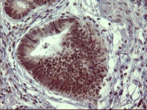 Immunohistochemical staining of paraffin-embedded Carcinoma of Human pancreas tissue using anti-TH mouse monoclonal antibody. . Heat-induced epitope retrieval by EDTA solution buffer pH 8.0 at 120Â°C for 3 min.