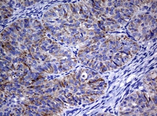 Immunohistochemical staining of paraffin-embedded Adenocarcinoma of Human ovary tissue using anti-POLI mouse monoclonal antibody. Heat-induced epitope retrieval by EDTA solution buffer pH 8.0 at 120Â°C for 3 min.