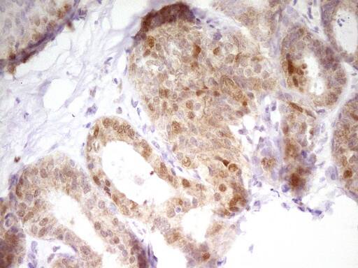 Immunohistochemical staining of paraffin-embedded Adenocarcinoma of Human breast tissue using anti-PAPSS2 mouse monoclonal antibody. Heat-induced epitope retrieval by EDTA solution buffer pH 8.0 at 120Â°C for 3 min.
