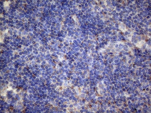 Immunohistochemical staining of paraffin-embedded Carcinoma of Human lung tissue using anti-PAPSS2 mouse monoclonal antibody. Heat-induced epitope retrieval by EDTA solution buffer pH 8.0 at 120Â°C for 3 min.