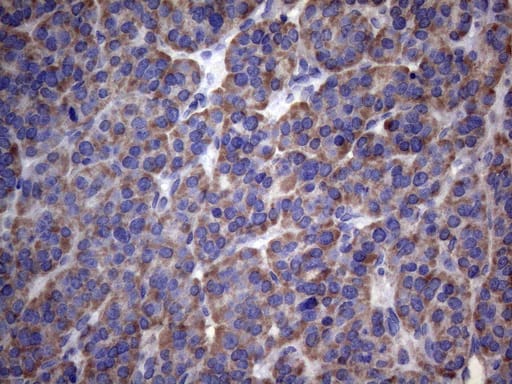 Immunohistochemical staining of paraffin-embedded Carcinoma of Human thyroid tissue using anti-PAPSS2 mouse monoclonal antibody. Heat-induced epitope retrieval by EDTA solution buffer pH 8.0 at 120Â°C for 3 min.