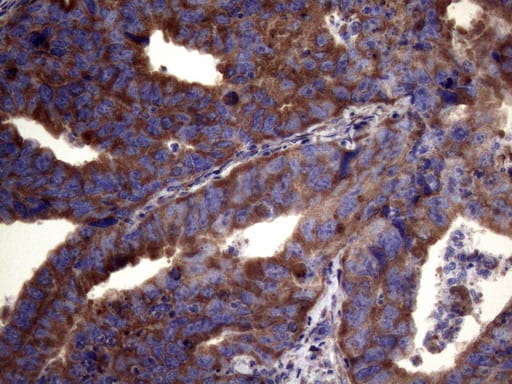 Immunohistochemical staining of paraffin-embedded Adenocarcinoma of Human colon tissue using anti-PAPSS2 mouse monoclonal antibody. Heat-induced epitope retrieval by EDTA solution buffer pH 8.0 at 120Â°C for 3 min.