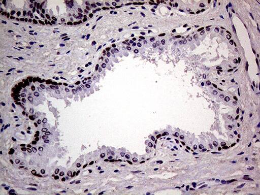 Immunohistochemical staining of paraffin-embedded Carcinoma of Human prostate tissue using anti-MAGEB4 mouse monoclonal antibody. Heat-induced epitope retrieval by EDTA solution buffer pH 8.0 at 120Â°C for 3 min.