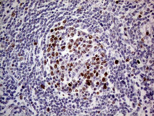 Immunohistochemical staining of paraffin-embedded Human lymph node tissue within the normal limits using anti-MAGEB4 mouse monoclonal antibody. Heat-induced epitope retrieval by EDTA solution buffer pH 8.0 at 120Â°C for 3 min.