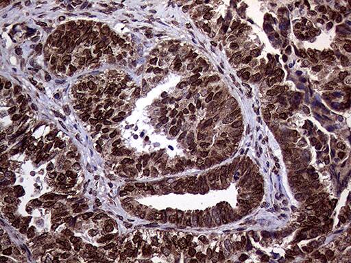 Immunohistochemical staining of paraffin-embedded Adenocarcinoma of Human endometrium tissue using anti-TRMT5 mouse monoclonal antibody. Heat-induced epitope retrieval by EDTA solution buffer pH 8.0 at 120Â°C for 3 min.