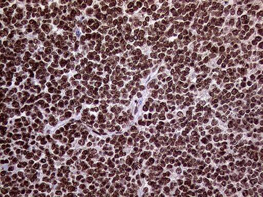 Immunohistochemical staining of paraffin-embedded Human lymphoma tissue using anti-TRMT5 mouse monoclonal antibody. Heat-induced epitope retrieval by EDTA solution buffer pH 8.0 at 120Â°C for 3 min.
