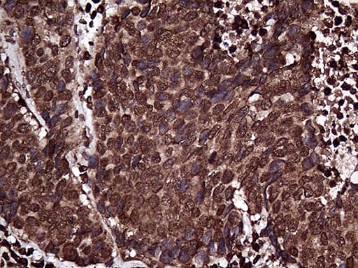 Immunohistochemical staining of paraffin-embedded Carcinoma of Human lung tissue using anti-RPL10A mouse monoclonal antibody. Heat-induced epitope retrieval by EDTA solution buffer pH 8.0 at 120Â°C for 3 min.
