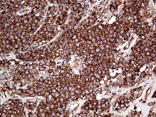 Immunohistochemical staining of paraffin-embedded Human lymphoma tissue using anti-RPL10A mouse monoclonal antibody. Heat-induced epitope retrieval by EDTA solution buffer pH 8.0 at 120Â°C for 3 min.