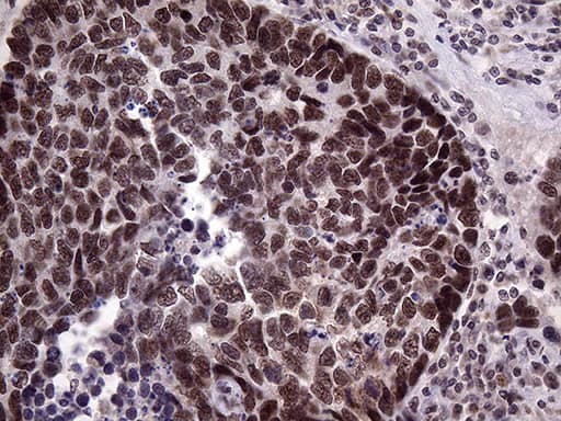 Immunohistochemical staining of paraffin-embedded Carcinoma of Human lung tissue using anti-LHX4 mouse monoclonal antibody. Heat-induced epitope retrieval by EDTA solution buffer pH 8.0 at 120Â°C for 3 min.
