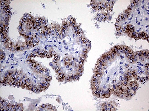 Immunohistochemical staining of paraffin-embedded Carcinoma of Human thyroid tissue using anti-MYOT mouse monoclonal antibody. Heat-induced epitope retrieval by EDTA solution buffer pH 8.0 at 120Â°C for 3 min.