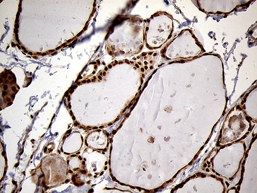 Immunohistochemical staining of paraffin-embedded Human thyroid tissue within the normal limits using anti-MEIS1 mouse monoclonal antibody. Heat-induced epitope retrieval by EDTA solution buffer pH 8.0 at 120Â°C for 3 min.