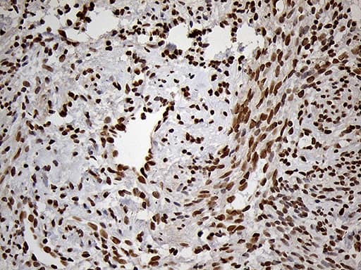 Immunohistochemical staining of paraffin-embedded Human endometrium tissue within the normal limits using anti-MEIS1 mouse monoclonal antibody. Heat-induced epitope retrieval by EDTA solution buffer pH 8.0 at 120Â°C for 3 min.