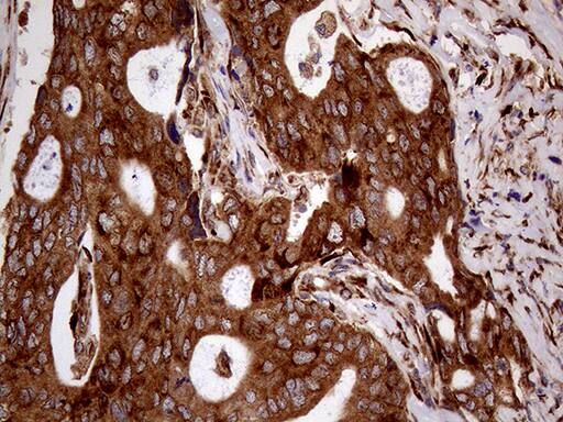 Immunohistochemical staining of paraffin-embedded Adenocarcinoma of Human breast tissue tissue using anti-RRBP1 mouse monoclonal antibody. Heat-induced epitope retrieval by EDTA solution buffer pH 8.0 at 120Â°C for 3 min.