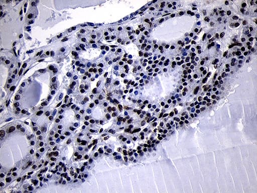 Immunohistochemical staining of paraffin-embedded Carcinoma of Human thyroid tissue using anti-HOXC4 mouse monoclonal antibody. Heat-induced epitope retrieval by EDTA solution buffer pH 8.0 at 120Â°C for 3 min.