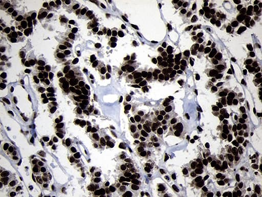 Immunohistochemical staining of paraffin-embedded Carcinoma of Human pancreas tissue using anti-HOXC4 mouse monoclonal antibody. Heat-induced epitope retrieval by EDTA solution buffer pH 8.0 at 120Â°C for 3 min.