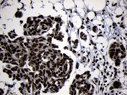 Immunohistochemical staining of paraffin-embedded Adenocarcinoma of Human ovary tissue using anti-HOXC4 mouse monoclonal antibody. Heat-induced epitope retrieval by EDTA solution buffer pH 8.0 at 120Â°C for 3 min.