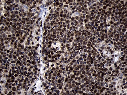 Immunohistochemical staining of paraffin-embedded Human lymphoma tissue using anti-HOXC4 mouse monoclonal antibody. Heat-induced epitope retrieval by EDTA solution buffer pH 8.0 at 120Â°C for 3 min.